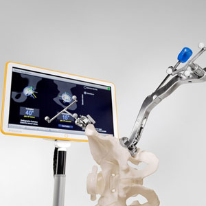 computer navigation in joint replacement
