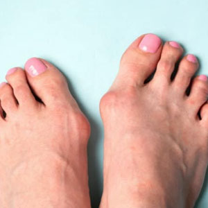 TKR in Severe Deformity and Bone Loss