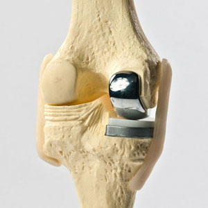Unicompartmental Knee Replacement in Guntur